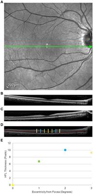 Henle fiber layer thickening and deficits in objective retinal function in participants with a history of multiple traumatic brain injuries